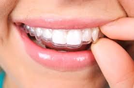 The Benefits of Choosing Invisalign in Selkirk for Straighter Teeth